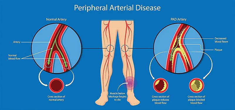 peripheral artery disease