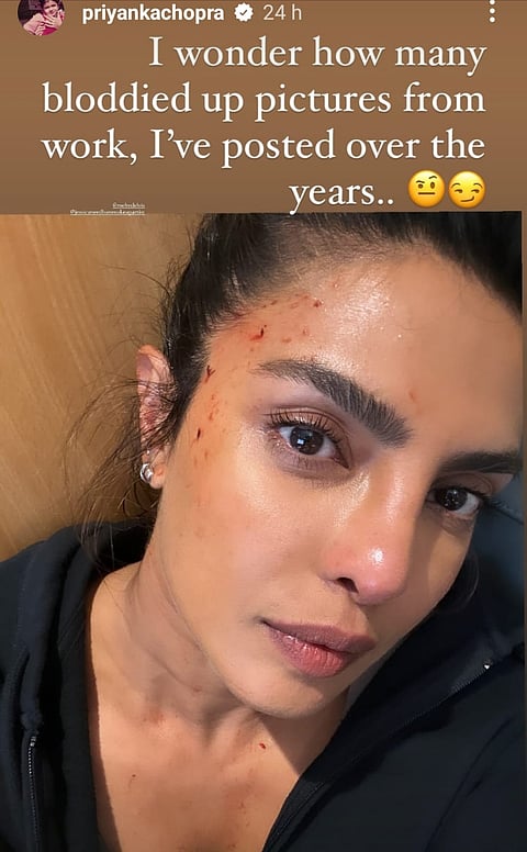Priyanka Chopra shares pic of her injury