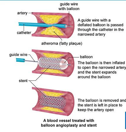 A blood vessel treated with balloon angioplasty and stent