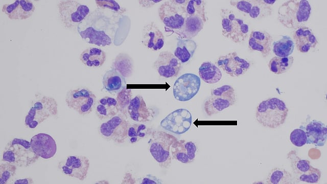 Kerala: Brain-Eating Amoeba Kills 5-Year-Old Girl In Malappuram | All About The Disease
