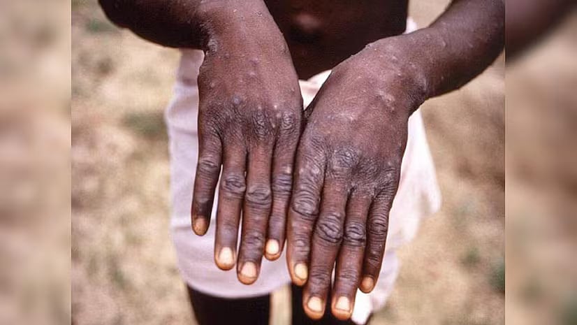 | Photo: AP : Philippines Detects First Case Of Monkeypox Virus