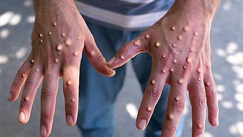 Mpox outbreak 