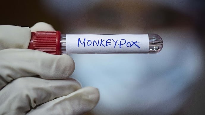 Monkeypox Explained: Symptoms, Causes, And Recent Cases In India