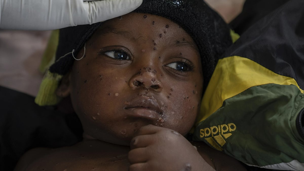 AP : A child suffering from Mpox in Kamituga, Congo.