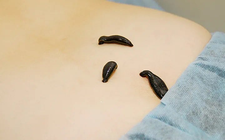 The Comeback Of Medicinal Leeches: Their Role In Modern Medicine