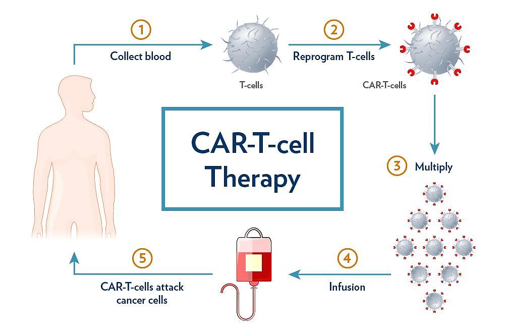 CAR T-Cell Therapy