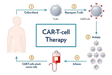 CAR T-Cell Therapy In India: A New Hope For Cancer Treatment