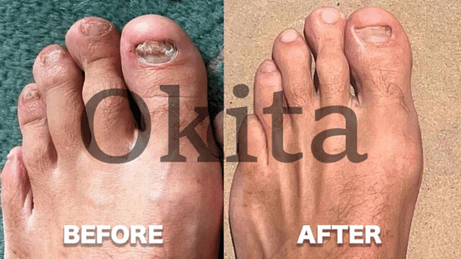 Okita Toenail Fungus Pen Effects