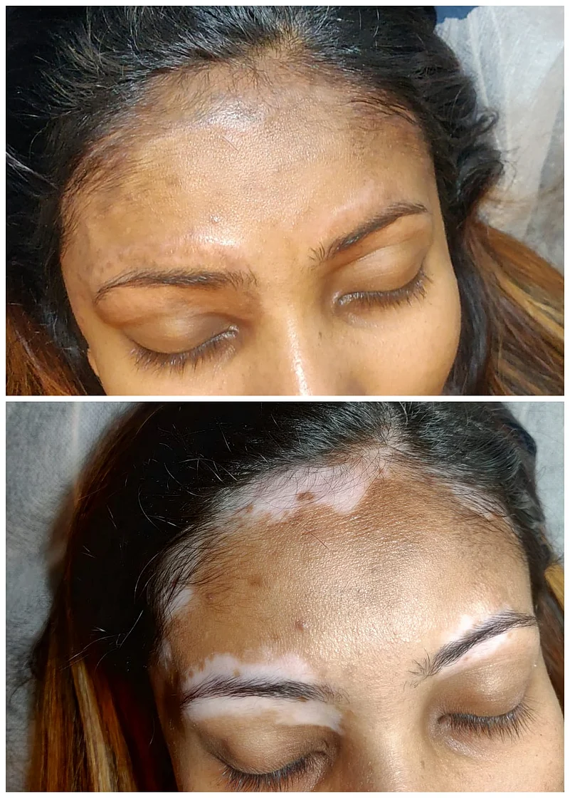 Micropigmentation