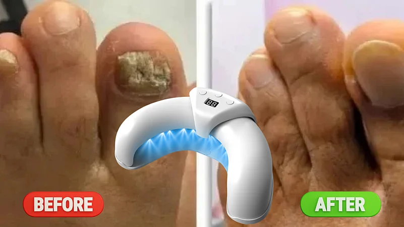 Podoclear LLLT Device Before And After