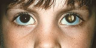Retinoblastoma: Early Detection Saves Children’s Sight And Lives
