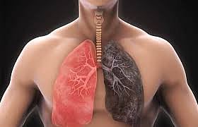 Monitoring CAVI May Improve COPD Management And Help Evaluate Disease Progression: Study