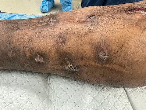 Researchers Link Iron To Mycetoma's Deadly Progress, Offer Hope To Patients
