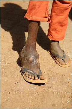 Mycetoma: A Neglected Disease Demands National Attention