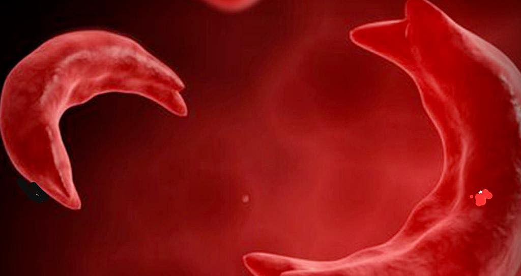 National Sickle Cell Anemia Elimination Mission: Over 18.85 Lakh Identified, Highlighting Urgent Health Challenge