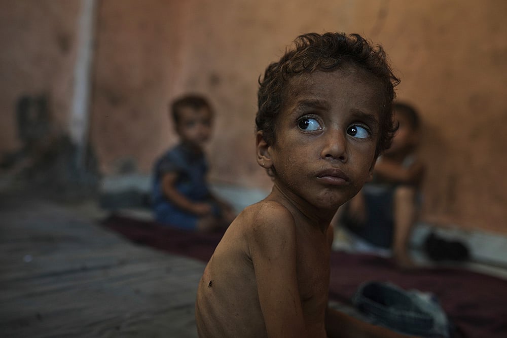 Photo: AP/Jehad Alshrafi : Yazan Abu Ful, a 2-year-old malnourished child