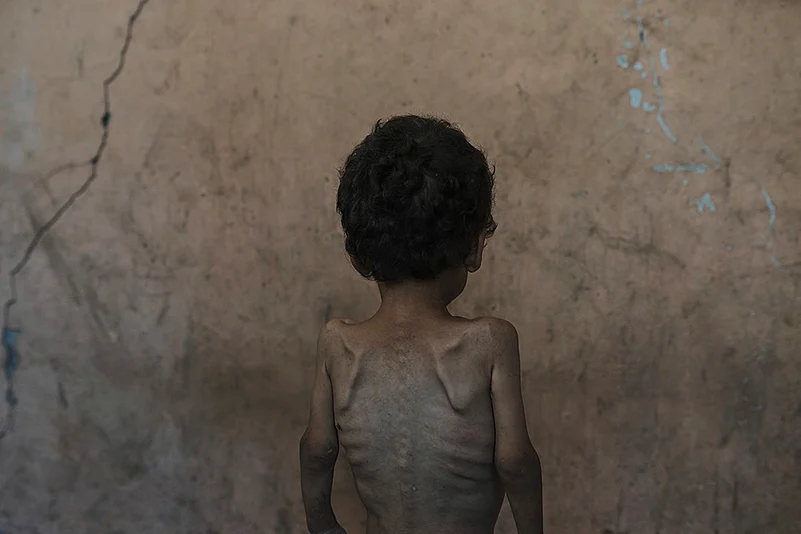 Yazan Abu Ful, a 2-year-old malnourished child