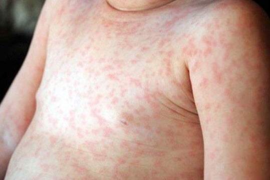 Nepal Eliminates Rubella, Earns WHO Praise; India Strives To Meet 2026 Target