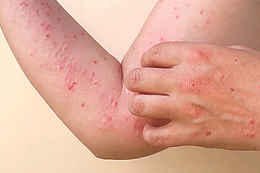 Alarming Resurgence Of Chikungunya Virus In 2025 Poses Global Health Threat: WHO