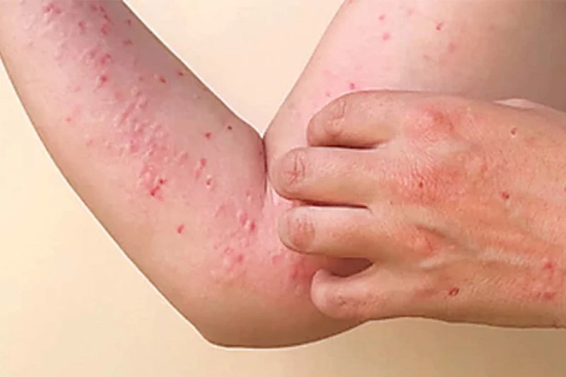 Person scratching red, itchy rash on arm with small raised bumps and irritation on the skin