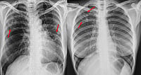 Chest X-Rays Fall Short In Detecting Silent Tuberculosis Cases, Says Study