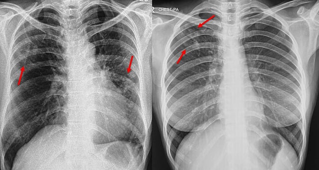 Chest X-Rays Fall Short In Detecting Silent Tuberculosis Cases, Says Study