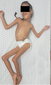 Delhi BJP MP Urges PM To Formulate Special Policy For LAMA2-CMD Treatment