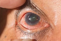 Study Links Trabeculectomy To Improved Quality Of Life In Glaucoma Patients