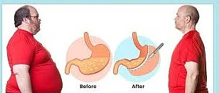 metabolic surgery before and after infographic