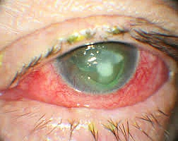 Fungal Eye Infection