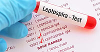 First-Ever Human Leptospirosis Detected In Meghalaya, Researchers Sound Public Health Alarm First-Ever Human Leptospirosis Detected In Meghalaya, Researchers Sound Public Health Alarm