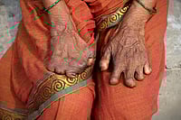 Leprosy Is Curable, The Real Challenge Is Stigma: WHO Leprosy Is Curable, The Real Challenge Is Stigma: WHO