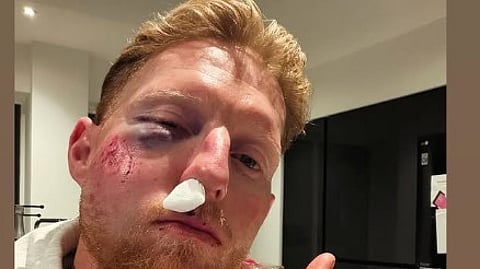 Ben Stokes shares his bruised image on his Instagram handle