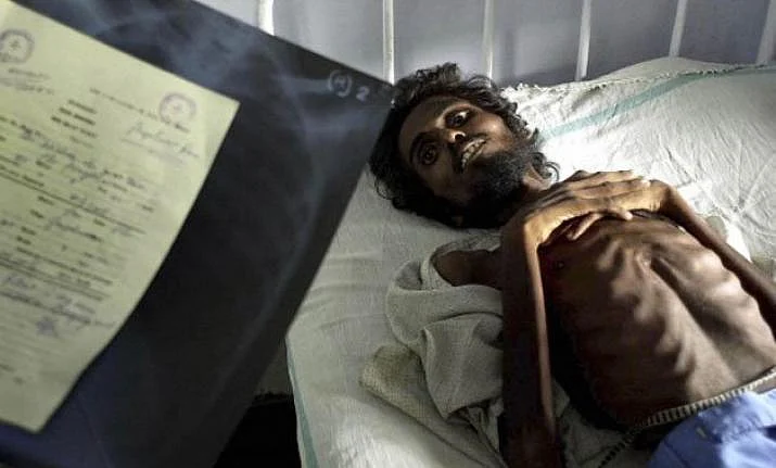 Severely thin man lies on hospital bed, ribs visible, medical chart blurred in foreground