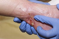 A Breakthrough Gel For Wounds That Refuse To Heal