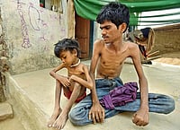 'Food Basket Helped Me Fight TB’: Study Says Nutrition Support Could Save Over 1 Lakh Lives A Year In India 'Food Basket Helped Me Fight TB’: Study Says Nutrition Support Could Save Over 1 Lakh Lives A Year In India