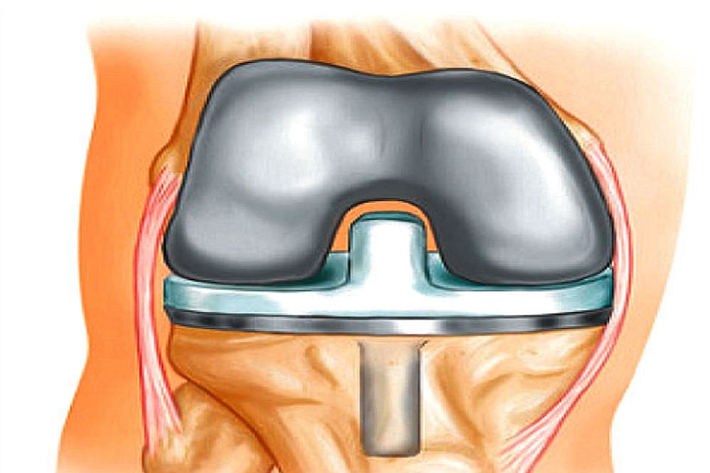 US Increases Pressure On Modi Govt, Asking Not To Extend Price Caps On Medical Devices