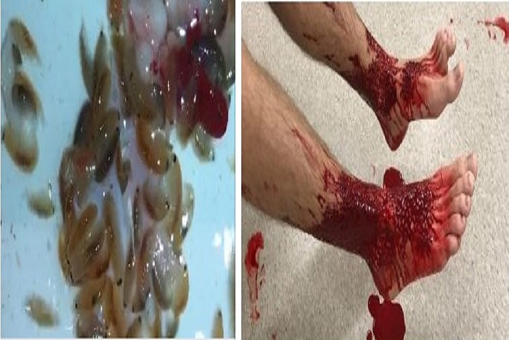 'Sea Bugs' Attack Melbourne Teen's Legs During Brighton Ocean Swim