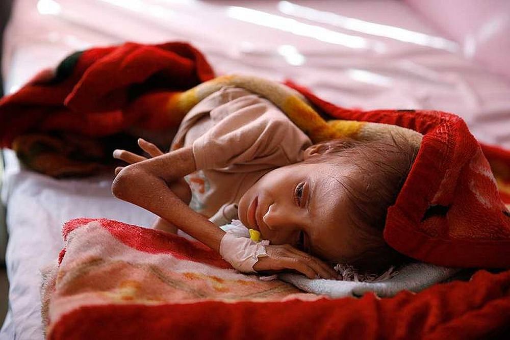 85,000 Children Died Of Malnutrition In Three Years In Yemen: Report