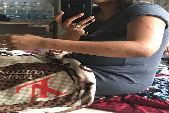 Air India Passenger Tweets Photo Of Bed Bug Bites, Recalls Flight Ordeal