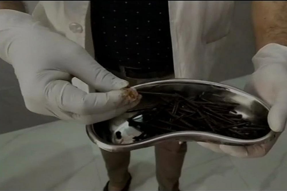 doctors find needles inside girl's head in odisha (representative image)