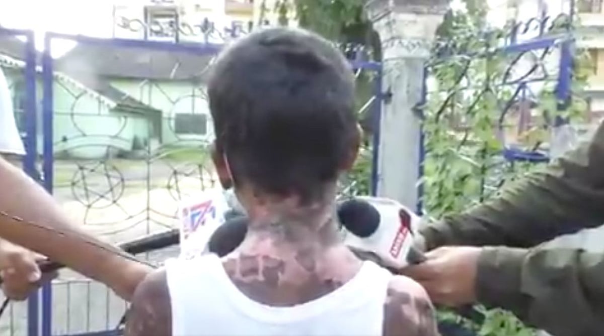 Assam Doctor, Wife Pour Hot Water On 12-Year-Old Domestic Help; Absconding