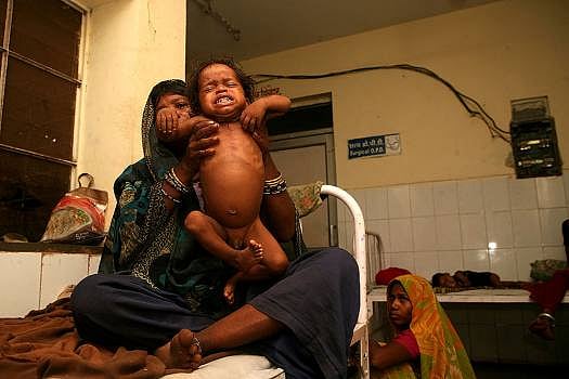 The Challenge Of Acute Malnutrition