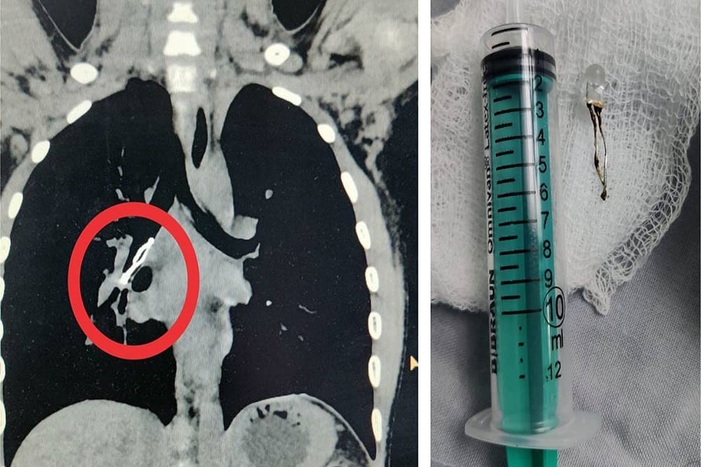 LED Toy Bulb Removed From 9-Year-Old’s Lungs In Telangana