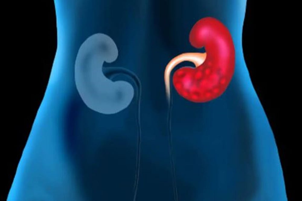 What Is End-Stage Kidney Failure?