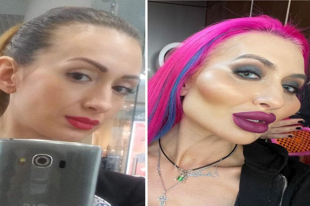 Ukrainian Model With World's Biggest Cheeks Share Pictures Before Transformation