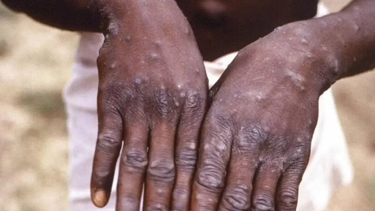 Suspected Case Of Monkeypox Found In Telangana