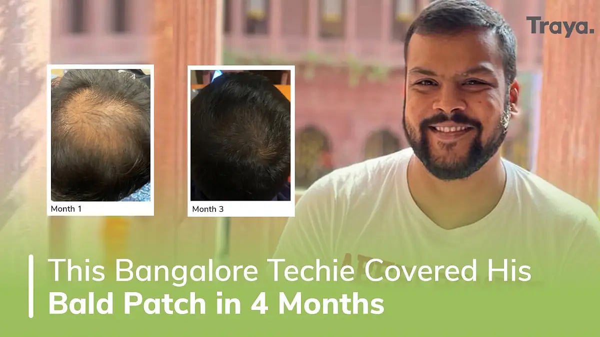 A holistic approach to treat hair loss- A sneak peek into Traya reviews 