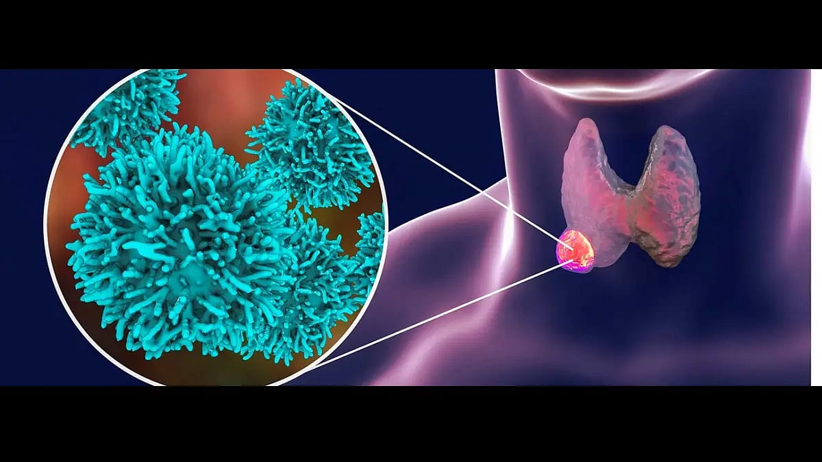 Effects of Covid-19 infection on thyroid gland
