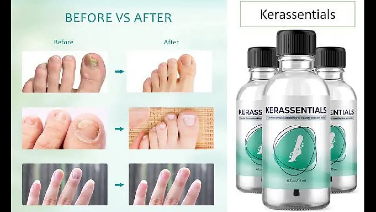 Kerassentials Reviews 